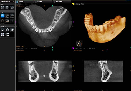 歯科用CT・デジタル3Dレントゲン写真